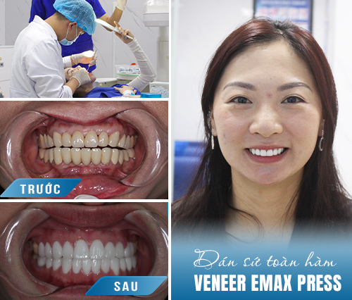 Dán sứ veneer