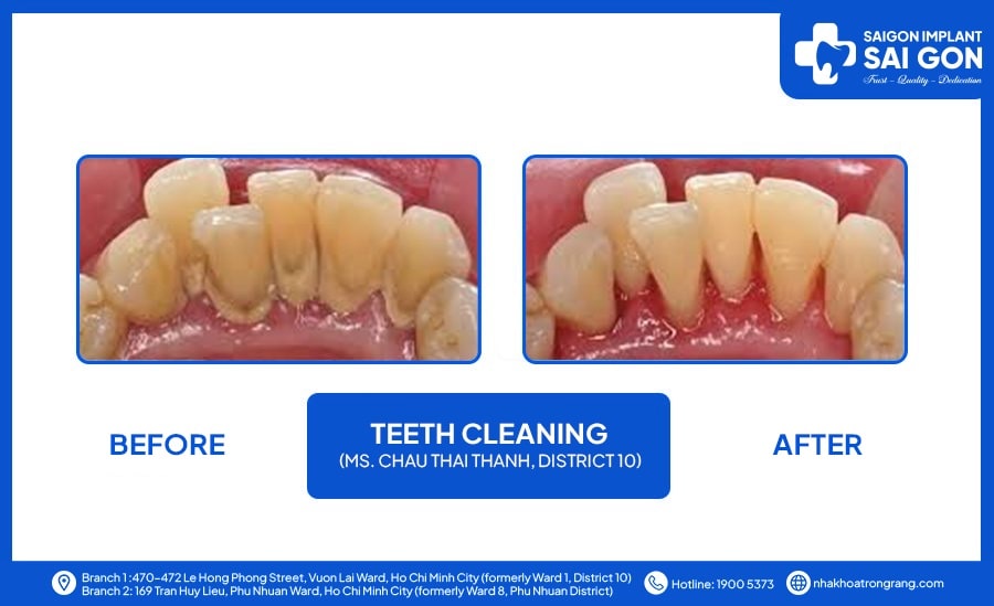 Ms chau thai thanh teeth cleaning Ms Chau Thai Thanh district 10 teeth cleaning