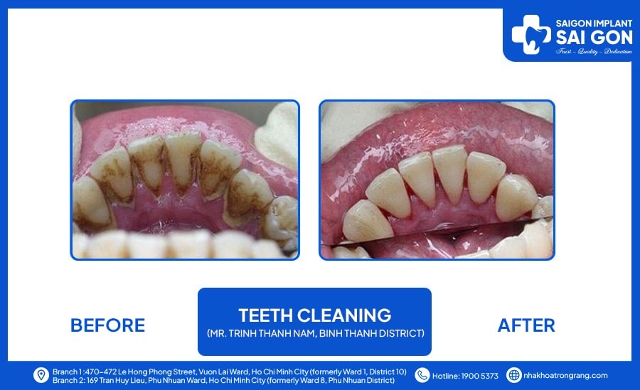mr trinh thanh nam Mr Trinh Thanh Nam, Binh Thanh district - Teeth cleaning
