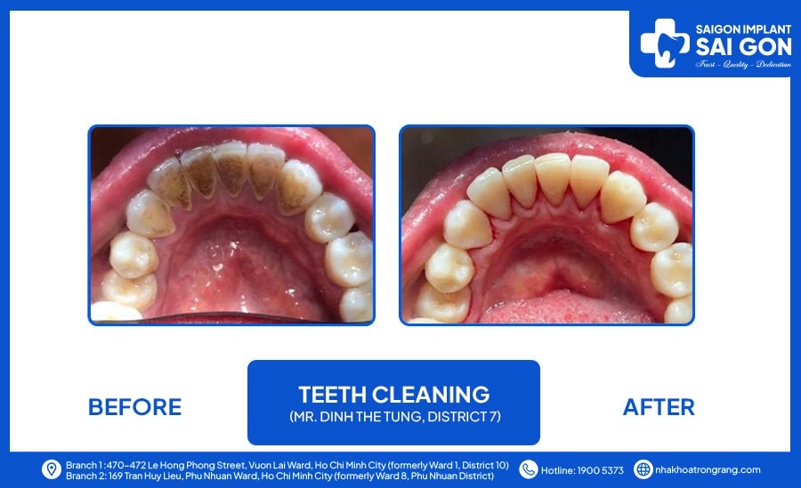 teeth cleaning mr dinh the tung Teeth cleaning Mr. Dinh The Tung, district 7