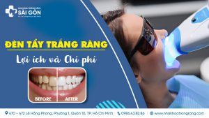 đèn tẩy trắng răng là gì