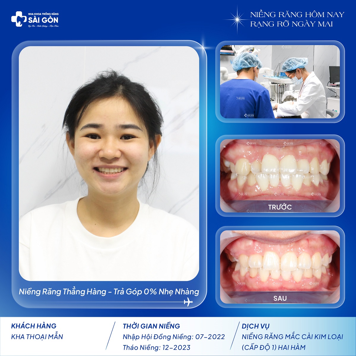 kha thoai man nieng rang mac cai kim loai cap do 1 Kha Thoại Mẫn niềng răng mắc cài kim loại (cấp độ 1) hai hàm tại Nha Khoa Trồng Răng Sài Gòn